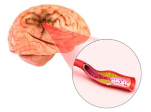 hipertensão e acidente vascular cerebral ou AVC