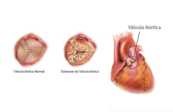 estenose aórtica causa dor no peito