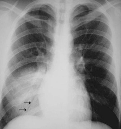 pneumonia e donças pulmonares causam dor no peito