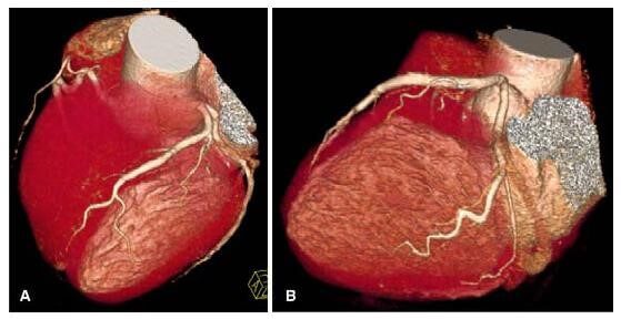 exame angiotomografia das coronárias