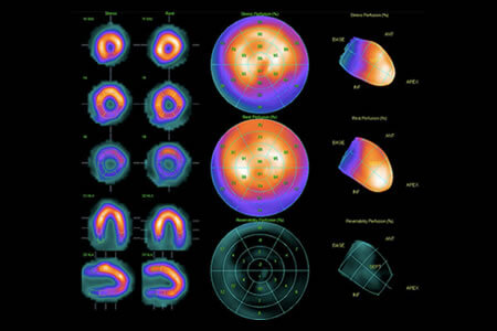 exame cintilografia miocárdica de perfusão